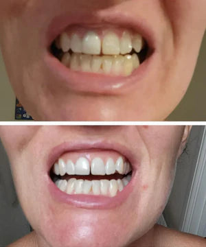 Bryte™ Purple Whitening Strips